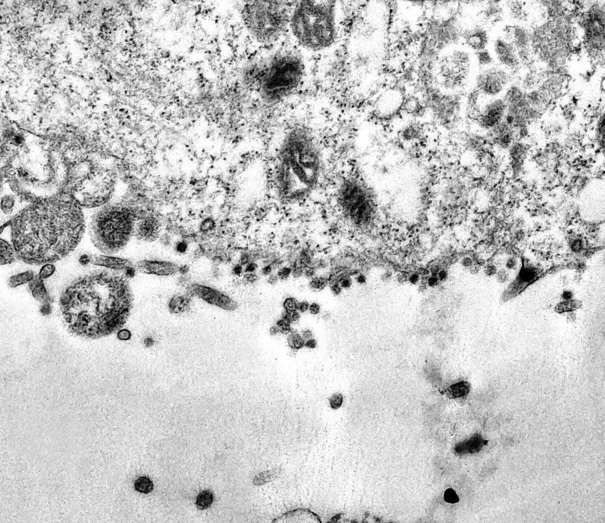 Imagen de la infección de la célula por el coronavirus. Imagen de la infección de la célula por el coronavirus.