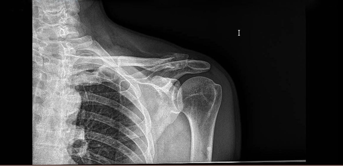 Radiografía de una fractura de clavícula Radiografía de una fractura de clavícula