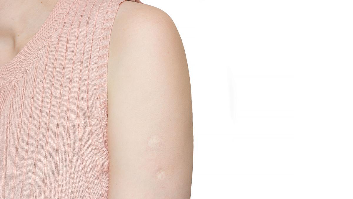 ¿La marca de la vacuna en el brazo es de la viruela?