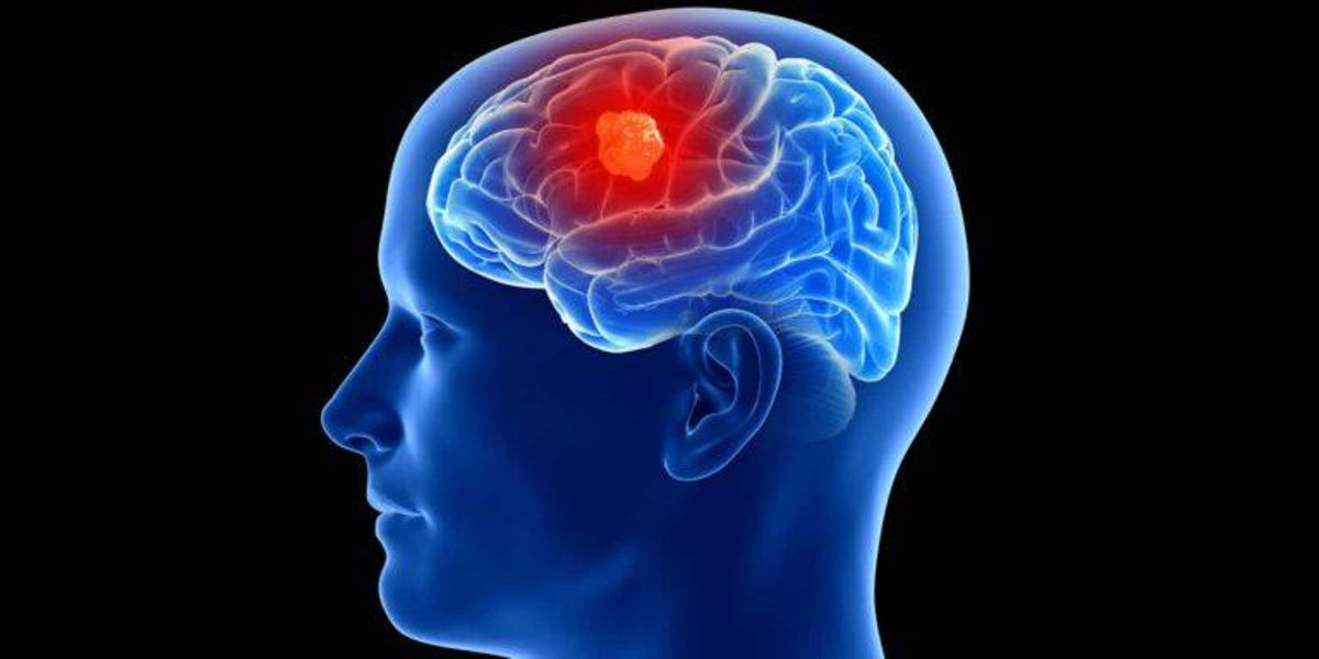 Día Internacional de los Tumores Cerebrales ¿Cuáles son los signos de la presencia de un tumor? Día Internacional de los Tumores Cerebrales ¿Cuáles son los signos de la presencia de un tumor?