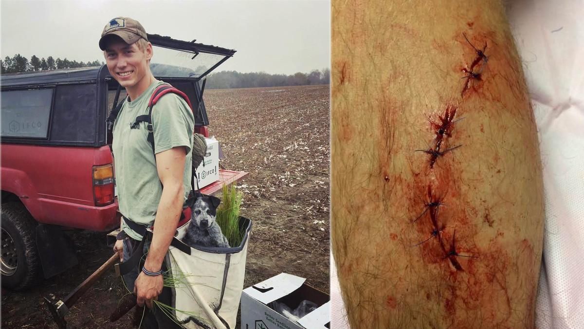 A la izquierda, Dylan McWilliams, el joven de 20 años que ha sobrevivido a los ataques de una serpiente, un oso y un tiburón. A la derecha, los siete puntos de sutura que recibió tras el ataque del tiburón, hace una semana. A la izquierda, Dylan McWilliams, el joven de 20 años que ha sobrevivido a los ataques de una serpiente, un oso y un tiburón. A la derecha, los siete puntos de sutura que recibió tras el ataque del tiburón, hace una semana.
