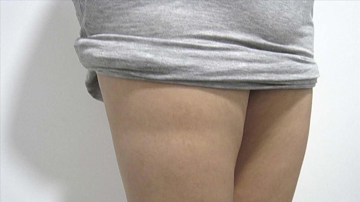 Marcas en los muslos provocadas por lipoatrofia semicircular. 
