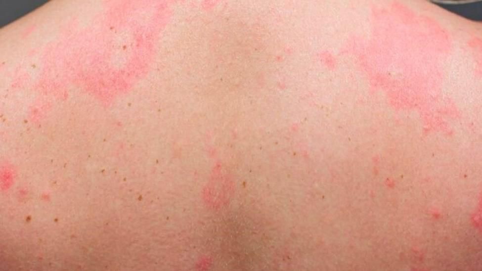 El sarpullido covid, ¿síntoma de la enfermedad o de la vacuna?