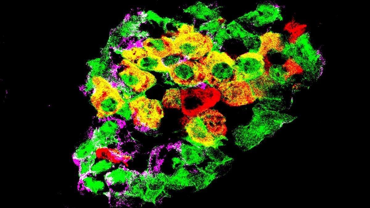 Islote pancreático de ratón en el que las células alfa productoras de glucagón (púrpura) se han etiquetado con una etiqueta fluorescente (verde). Algunos de ellos han comenzado a producir insulina (rojo), y aparecen como amarillo (combinación de verde y rojo).