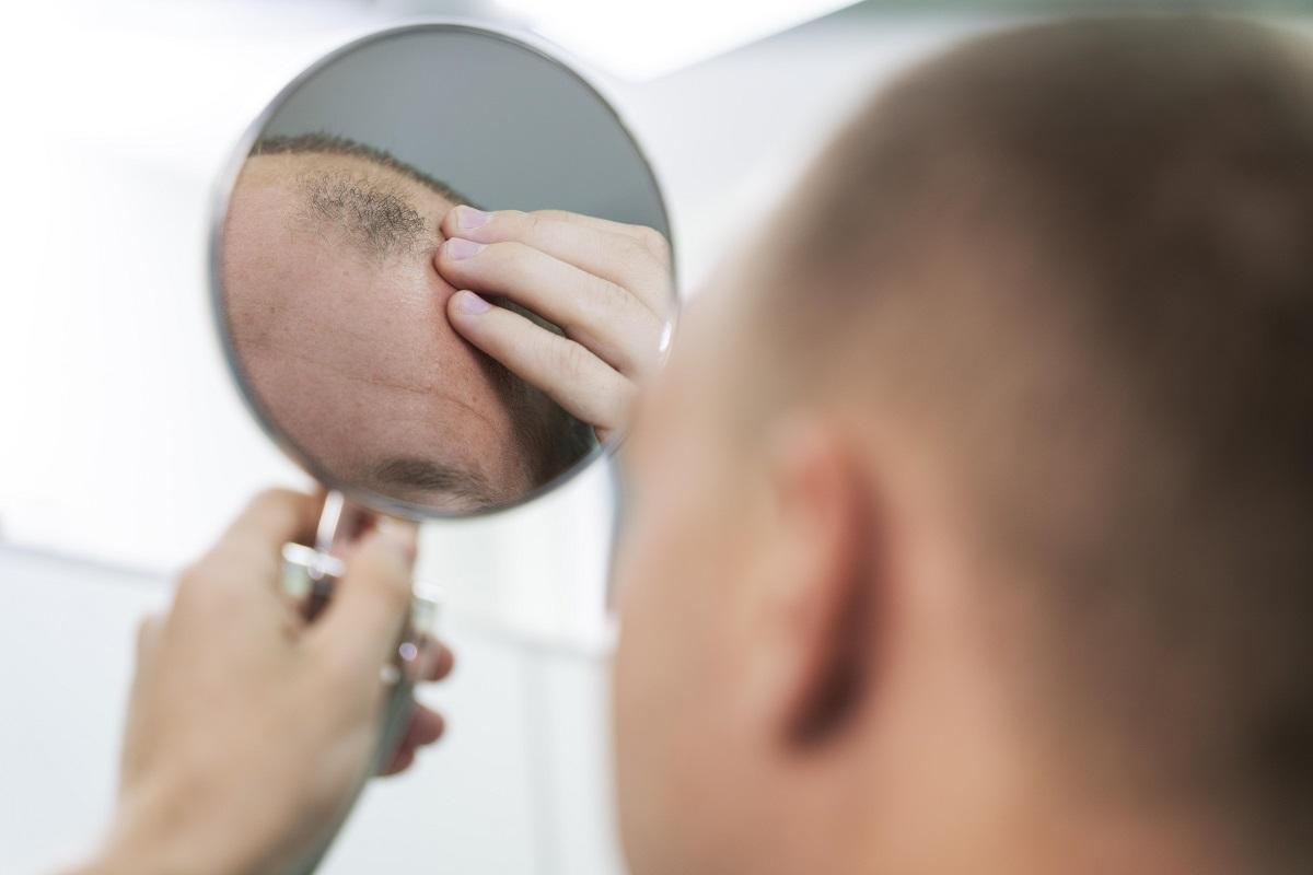Trasplante capilar: ¿quién puede hacérselo? ¿se puede realizar con todos los tipos de alopecia?