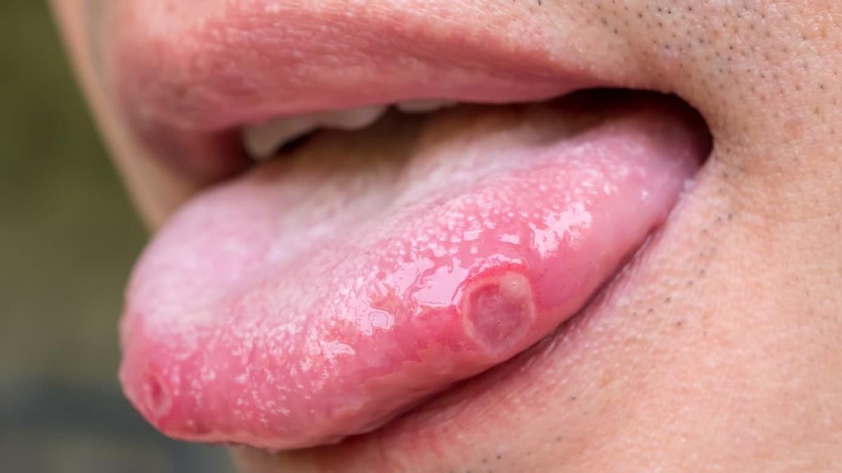 Imagen de archivo de una persona con llagas en la lengua.