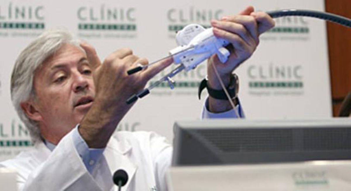 El doctor De Lacy, del Clínic, muestra el endoscopio que se introduce por la boca del paciente en la intervención. El doctor De Lacy, del Clínic, muestra el endoscopio que se introduce por la boca del paciente en la intervención.