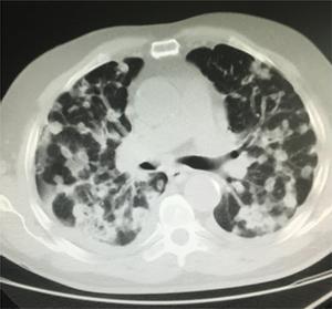 Imagen de un escáner de un pulmón con cáncer.