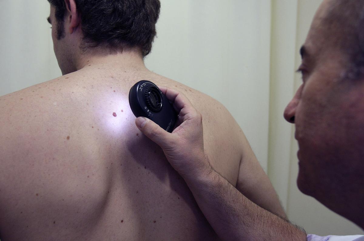 Un médico examina a un paciente para detectar o descartar posibles señales de cáncer de piel.