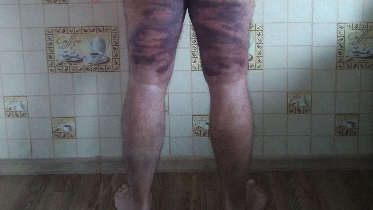Vladímir muestra los moratones que, según ha asegurado a EL PERIÓDICO, le ha provocado la policía bielorrusa durante su detención. Vladímir muestra los moratones que, según ha asegurado a EL PERIÓDICO, le ha provocado la policía bielorrusa durante su detención.