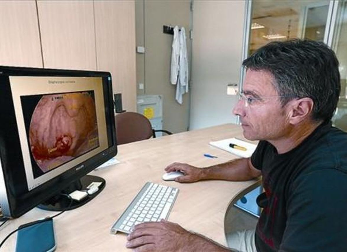 El epidemiólogo Xavier Castellsagué, del ICO, observa una garganta afectada por el virus del papiloma, ayer. El epidemiólogo Xavier Castellsagué, del ICO, observa una garganta afectada por el virus del papiloma, ayer.