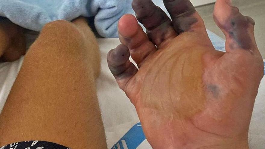 Una picadura de araña de Ibiza obliga por primera vez a amputar dedos en España - Vimarsana News
