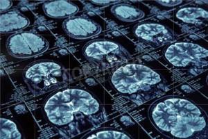 Imágenes de escáner de un cerebro.
