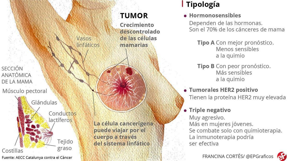 Cancer de mama - Traducción al rumano – Linguee, Que es cancer de seno