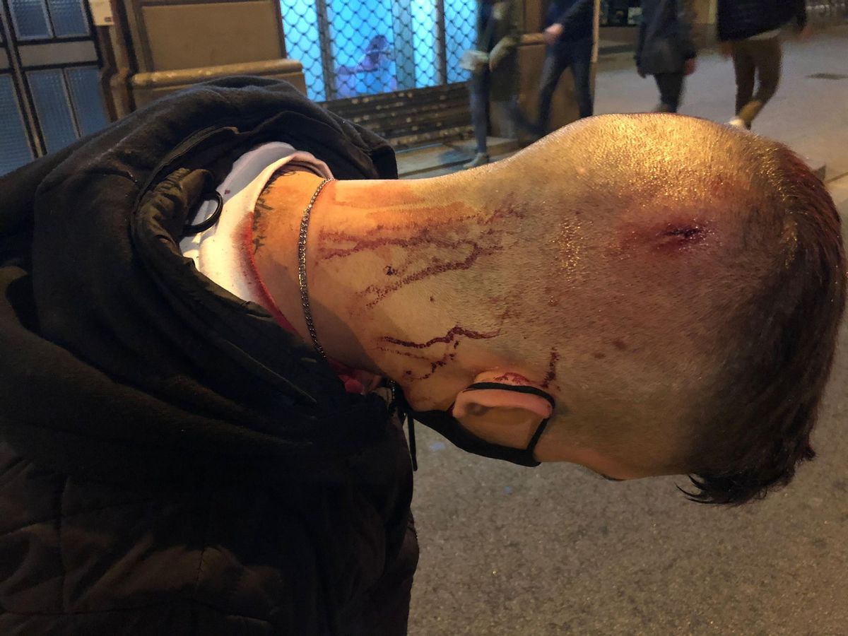 Ferida al cap d’un jove a la zona de Gràcia, el 20 de febrer, durant els disturbis posteriors a les protestes per Pablo Hasél Ferida al cap d’un jove a la zona de Gràcia, el 20 de febrer, durant els disturbis posteriors a les protestes per Pablo Hasél