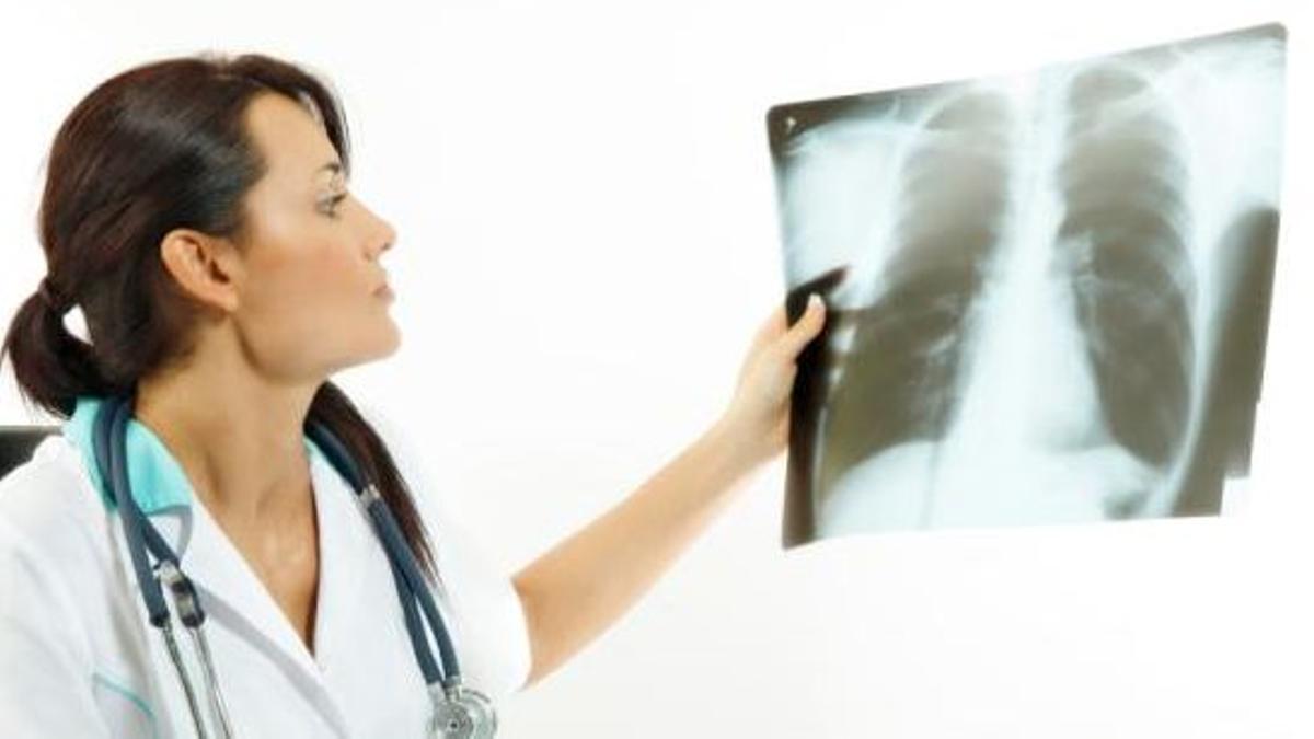 Preocupación por un nuevo perfil del cáncer de pulmón: mujer joven y no fumadora