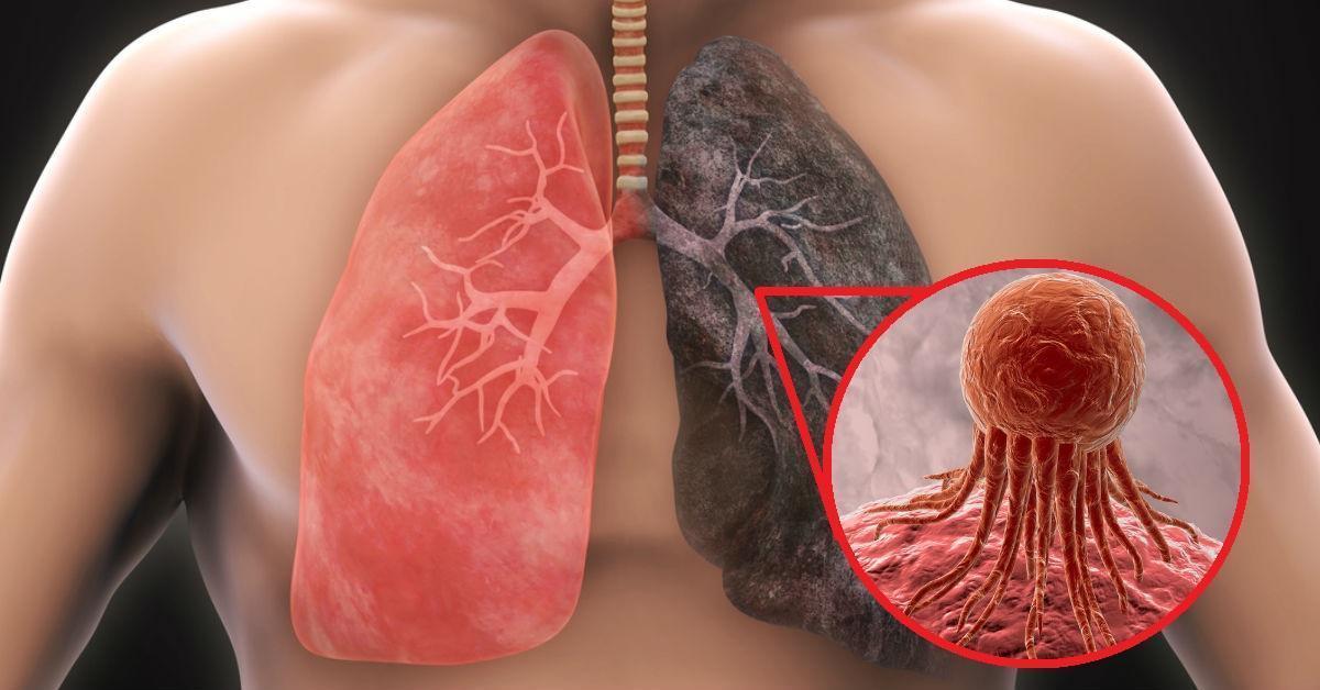 El de pulmón, es el tercer tumor más frecuente. /