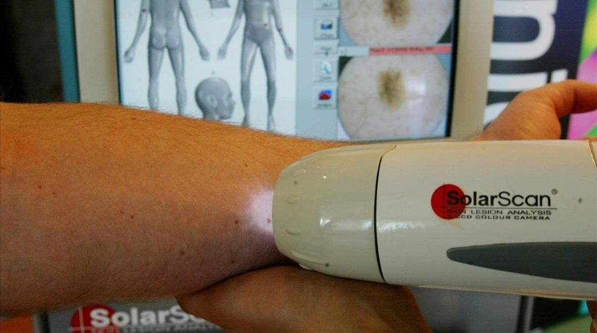 El escaner solar permite detectar casos de melanoma. El escaner solar permite detectar casos de melanoma.