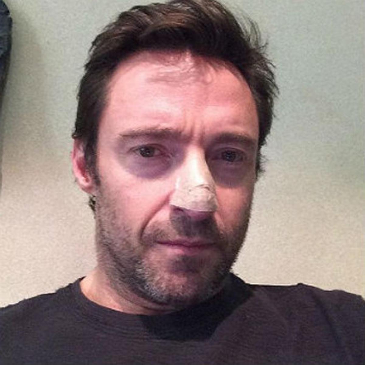 Hugh Jackman, con tiritas en la nariz, en la foto que ha colgado en Instagram.