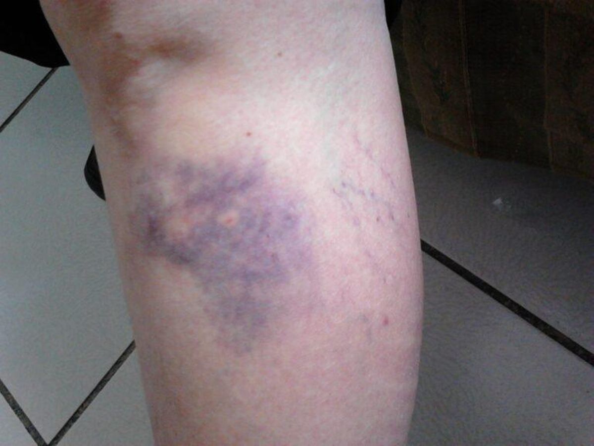 ¿Qué es la dermatomiositis? ¿Cómo se trata? ¿Qué es la dermatomiositis? ¿Cómo se trata?