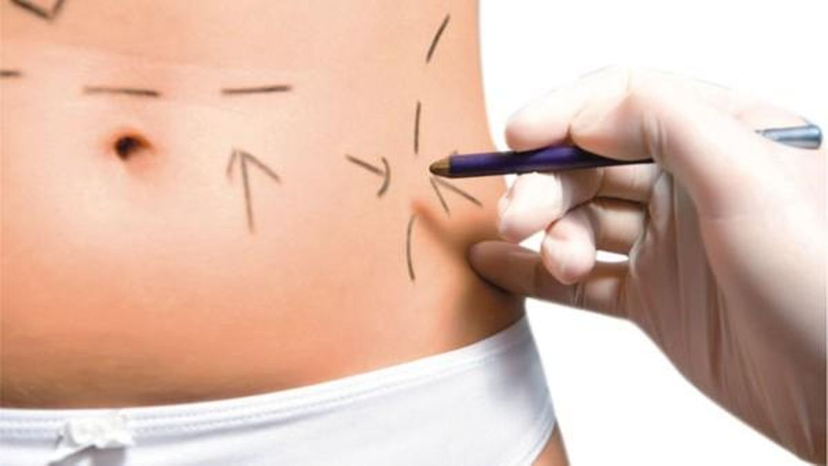 Lipoescultura, ¿què és i en què consisteix? Lipoescultura, ¿què és i en què consisteix?