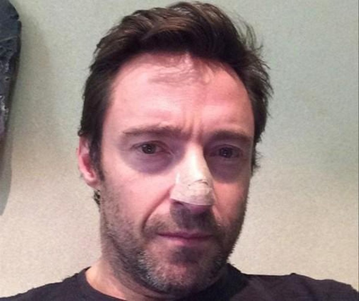 Hugh Jackman publicó esta imagen en su cuenta de Facebook, cuando se le disgnosticó el primer carcinoma en la nariz, en el 2013 Hugh Jackman publicó esta imagen en su cuenta de Facebook, cuando se le disgnosticó el primer carcinoma en la nariz, en el 2013