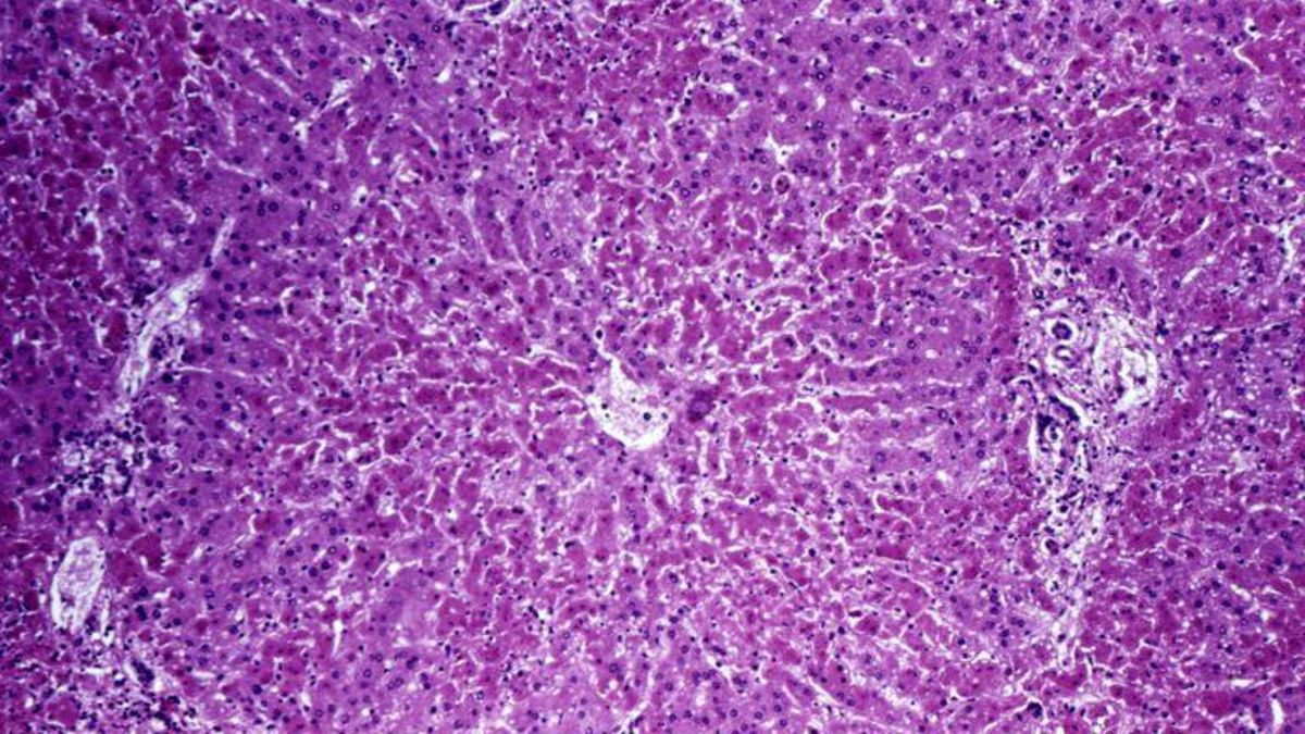 El sexto cáncer más común, y el segundo más mortífero ¡Se puede prevenir! El sexto cáncer más común, y el segundo más mortífero ¡Se puede prevenir!