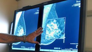 Un radiólogo compara mamografías hechas en 2D y en 3D.