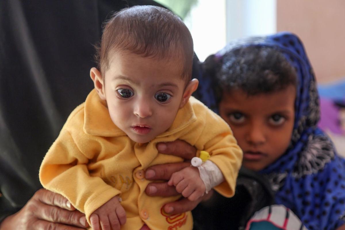 Una mujer aguanta un niño malnutrido en un centro sanitario en la ciudad de Taiz, Yemen. Una mujer aguanta un niño malnutrido en un centro sanitario en la ciudad de Taiz, Yemen.
