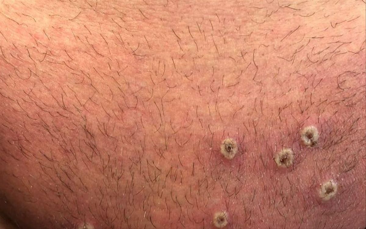 Madrid, con 210 casos confirmados de viruela del mono, no sabe si recibirá antivirales o vacunas ni cuándo llegarán Madrid, con 210 casos confirmados de viruela del mono, no sabe si recibirá antivirales o vacunas ni cuándo llegarán