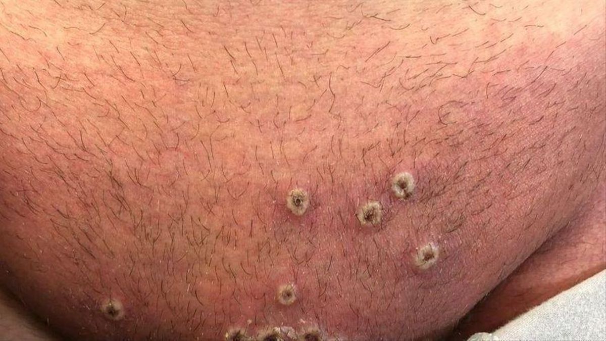 Marcas en la piel provocadas por la viruela del mono Marcas en la piel provocadas por la viruela del mono