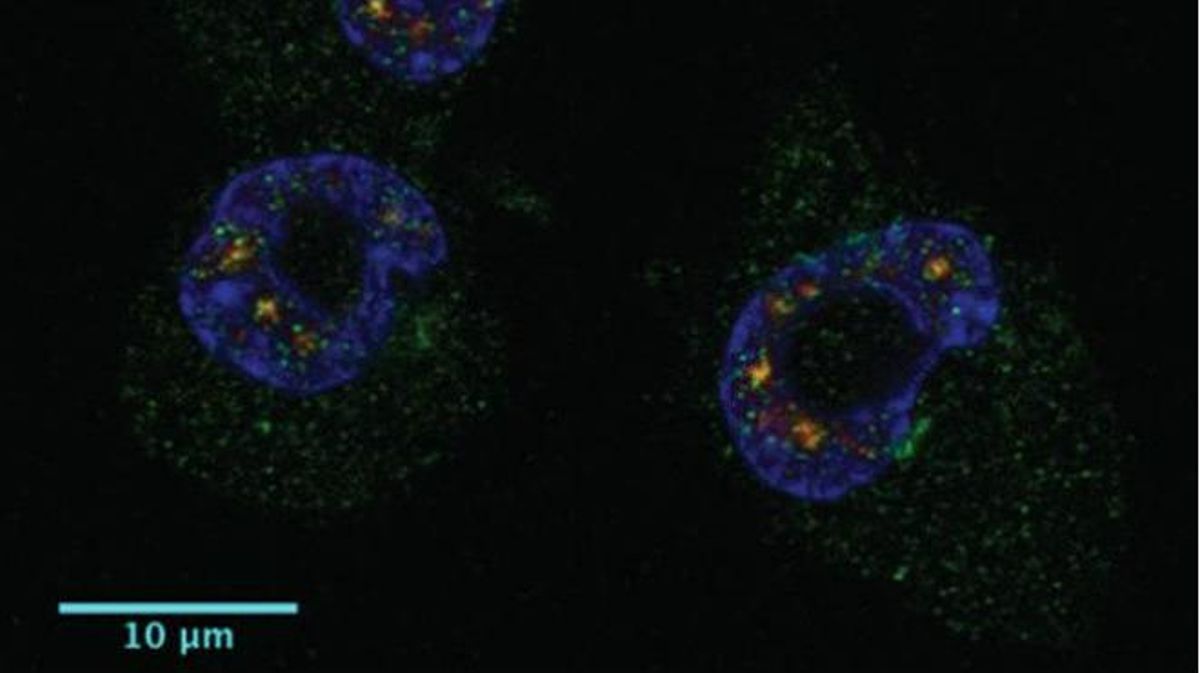 Metástasis del melanoma: descubierto el mecanismo que lo provoca Metástasis del melanoma: descubierto el mecanismo que lo provoca