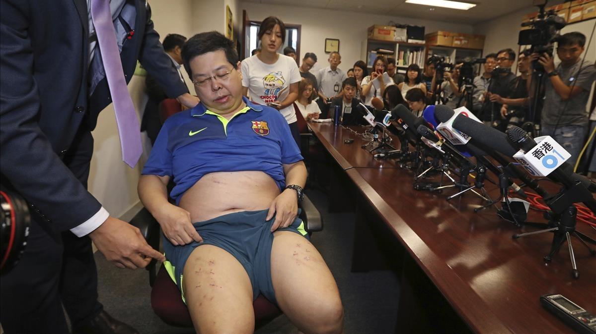 Howard Lam, con la camiseta del Barça, expone las heridas de sus piernas en una conferencia en Hong Kong el viernes 11 de agosto.