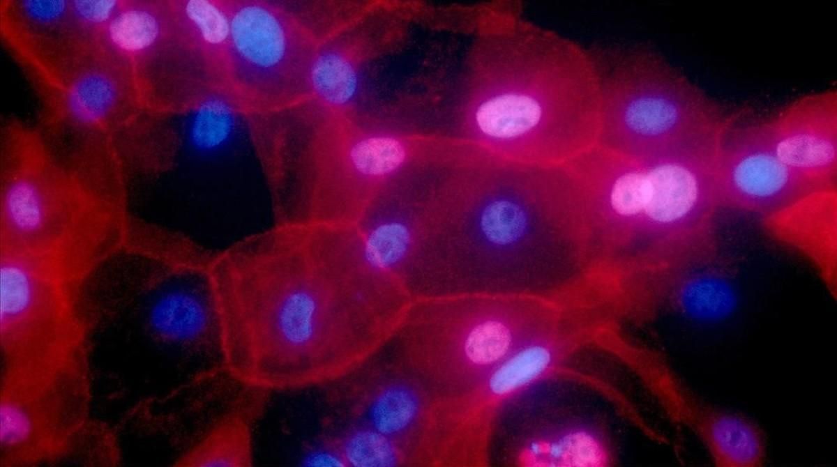 Células de cáncer de mama. Células de cáncer de mama.