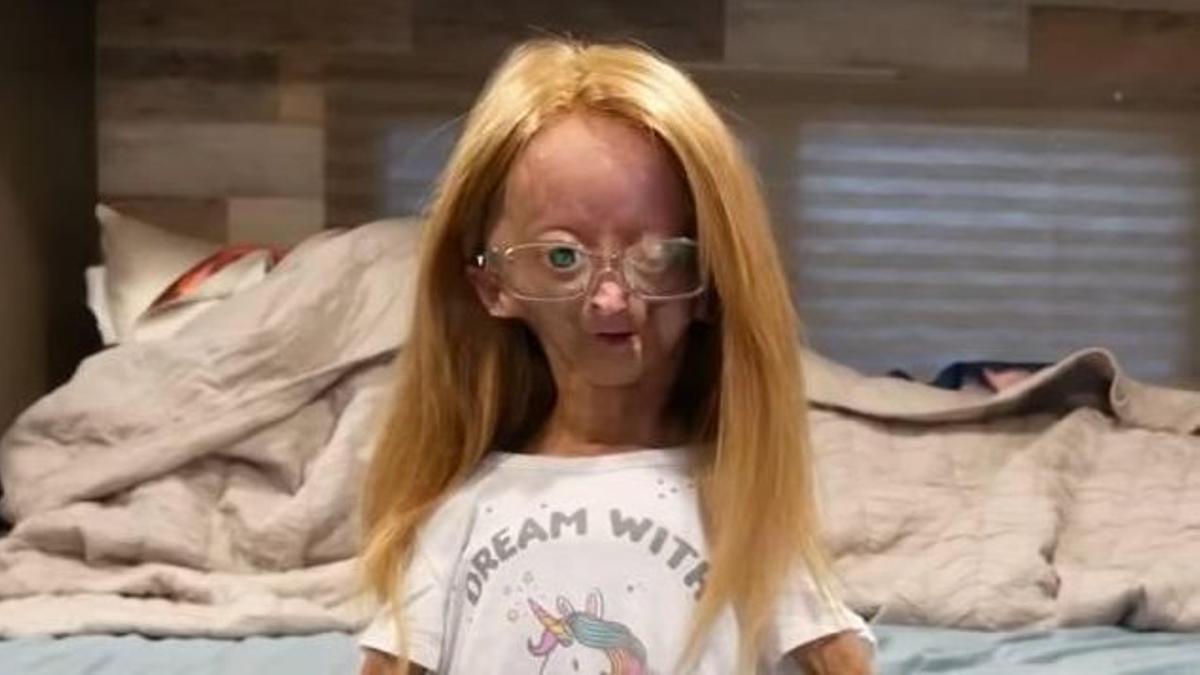 Adalia Rose Williams, ’youtuber’ con síndrome de Progeria de Hutchinson-Gilford.
