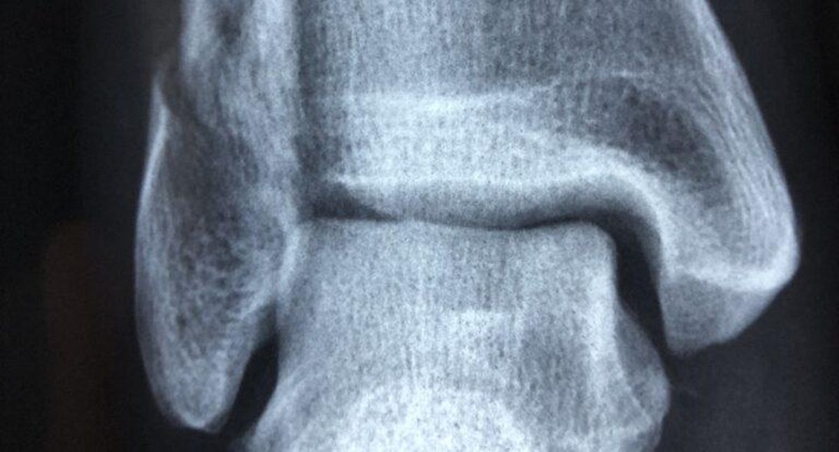 Osteoporosis: ¿Por qué se rompen tan fácil las vértebras, la cadera o las muñecas? Osteoporosis: ¿Por qué se rompen tan fácil las vértebras, la cadera o las muñecas?