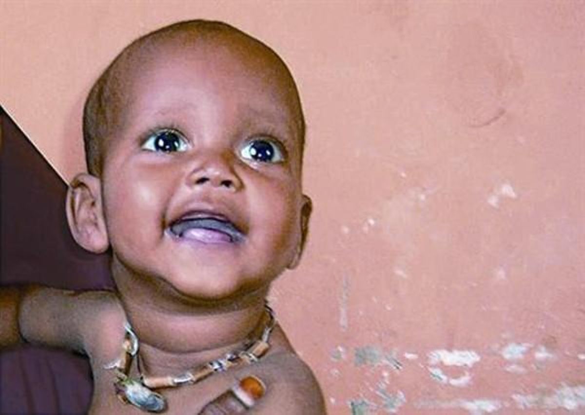 La evolución de Mohamed33 La foto superior muestra a Mohamed desnutrido y aquejado de diarrea en el momento de llegar al centro de atención que Oxfam Internacional tiene en Mogadiscio, la capital de Somalia. Debajo, Mohamed visiblemente recuperado seis semanas después tras ser sometido a un programa nutricional especial aplicado a los menores de cinco años con desnutrición severa. La evolución de Mohamed33 La foto superior muestra a Mohamed desnutrido y aquejado de diarrea en el momento de llegar al centro de atención que Oxfam Internacional tiene en Mogadiscio, la capital de Somalia. Debajo, Mohamed visiblemente recuperado seis semanas después tras ser sometido a un programa nutricional especial aplicado a los menores de cinco años con desnutrición severa.