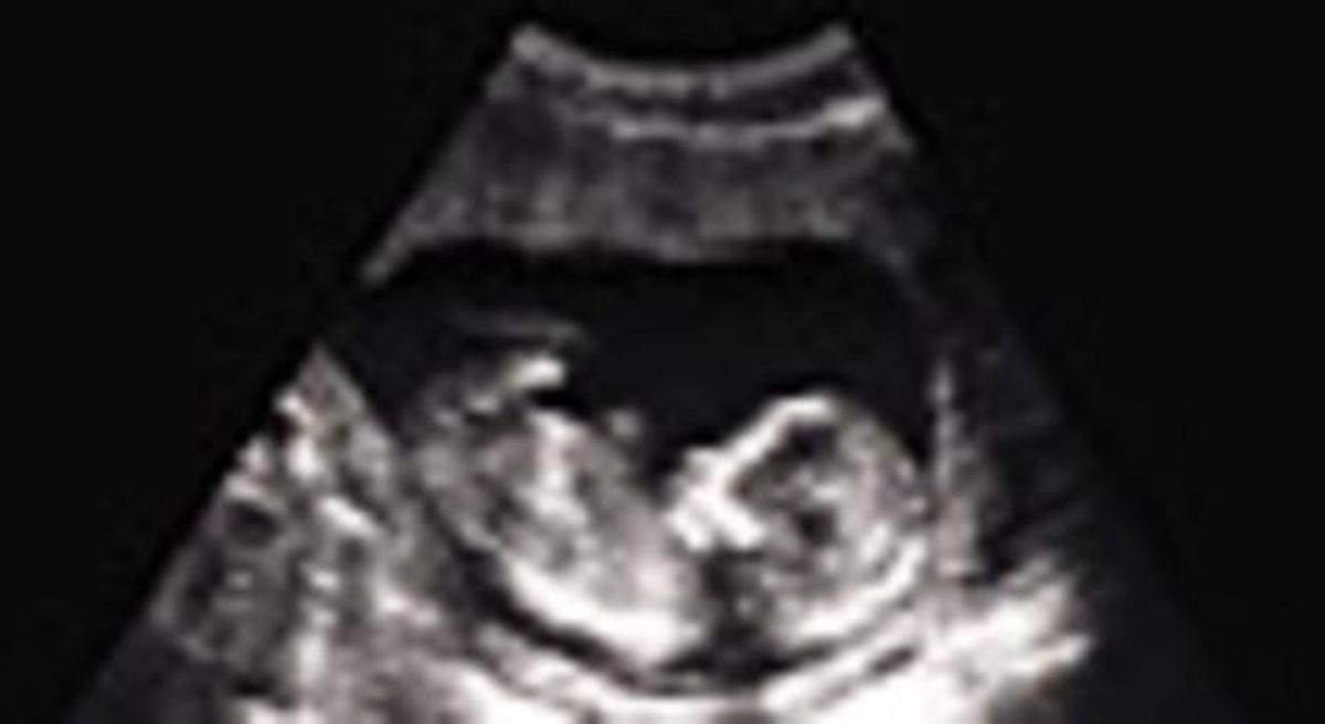 Ecografía de un feto de 14 semanas de gestación. Ecografía de un feto de 14 semanas de gestación.
