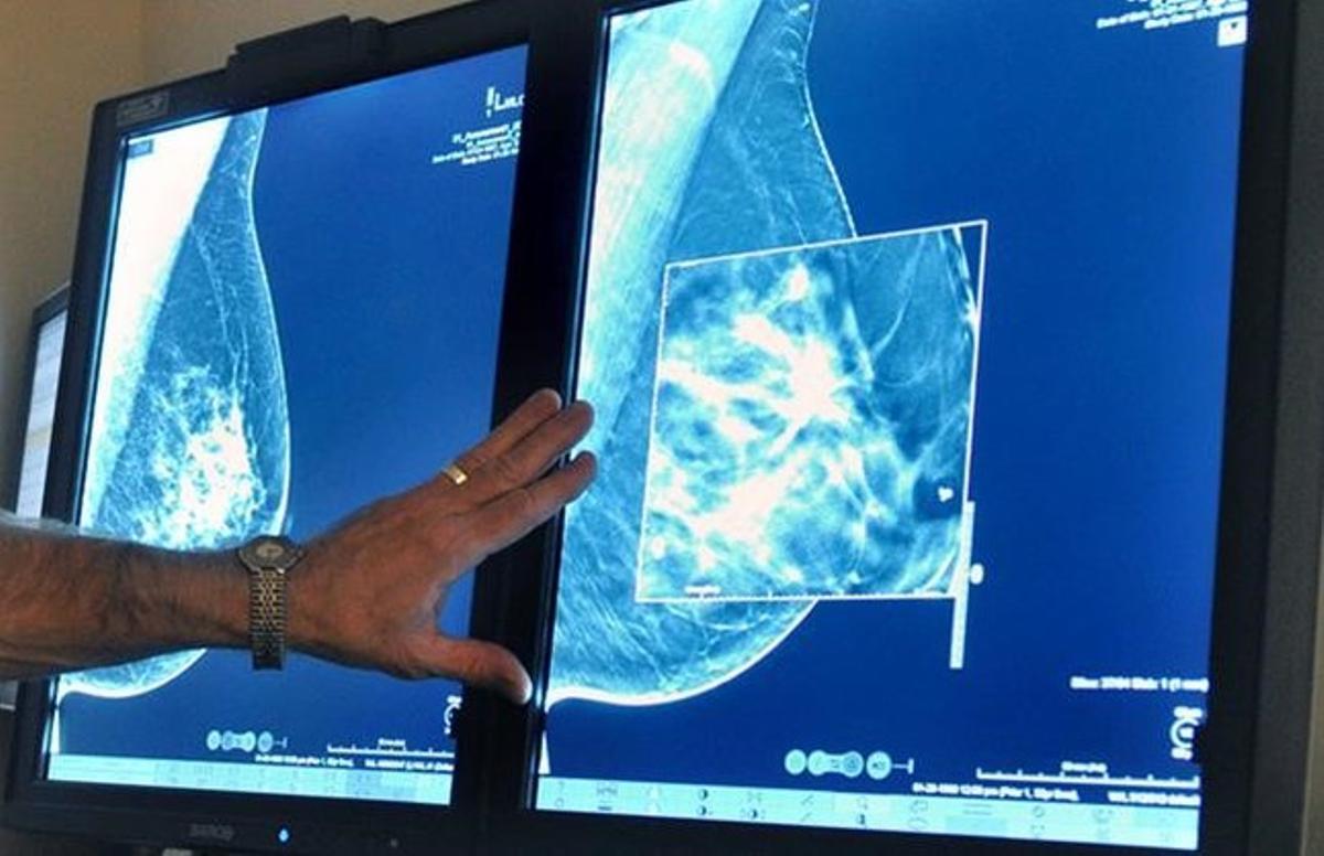 Mamografías para detectar tumores de mama.