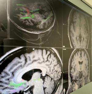 Imagen de las redes cerebrales estudiadas en un paciente con depresión.