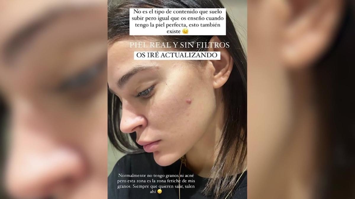 Laura Escanes comparte su piel real y sin filtros en las redes sociales.