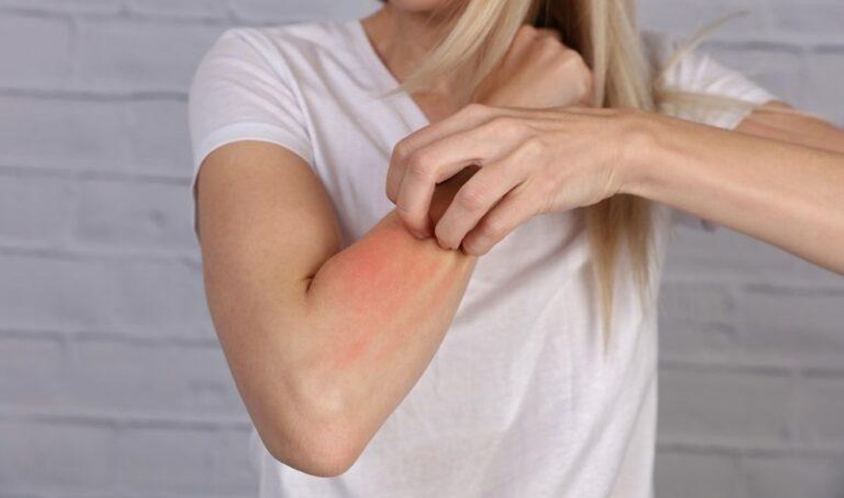 Urticaria crónica espontánea: así es el picor desesperante que afecta a todas las edades Urticaria crónica espontánea: así es el picor desesperante que afecta a todas las edades