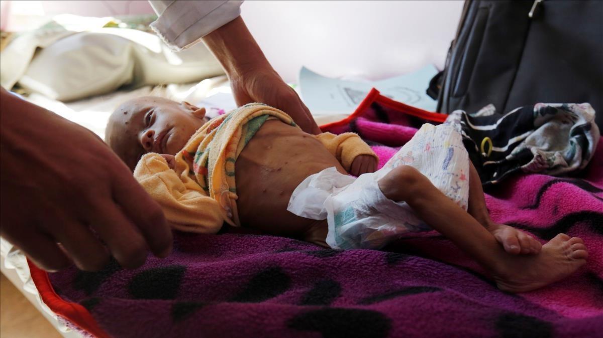 Un niño que sufre de desnutrición recibe tratamiento en un hospital de Saná, el 24 de noviembre.