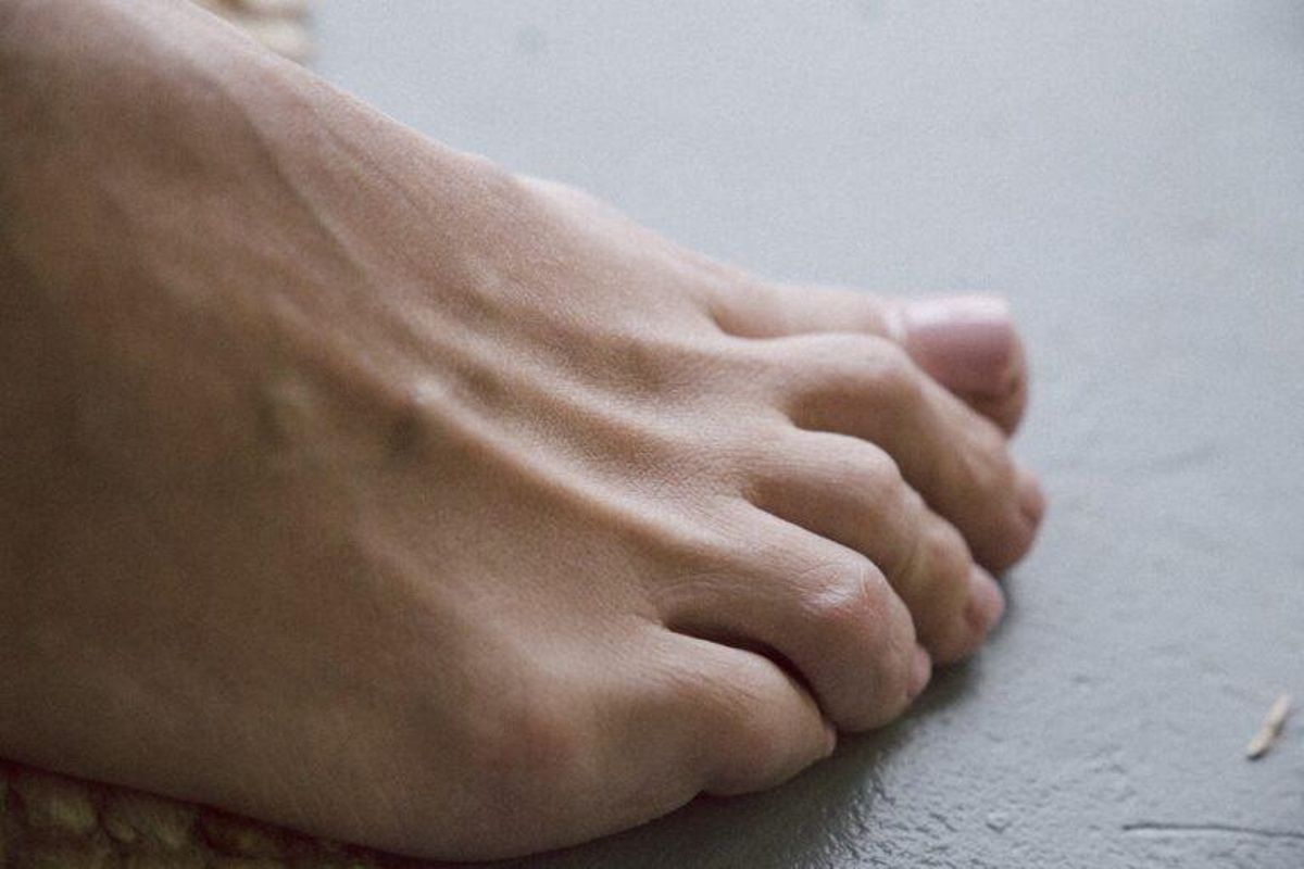 Callos en los pies: prevención, causas y tratamiento Callos en los pies: prevención, causas y tratamiento