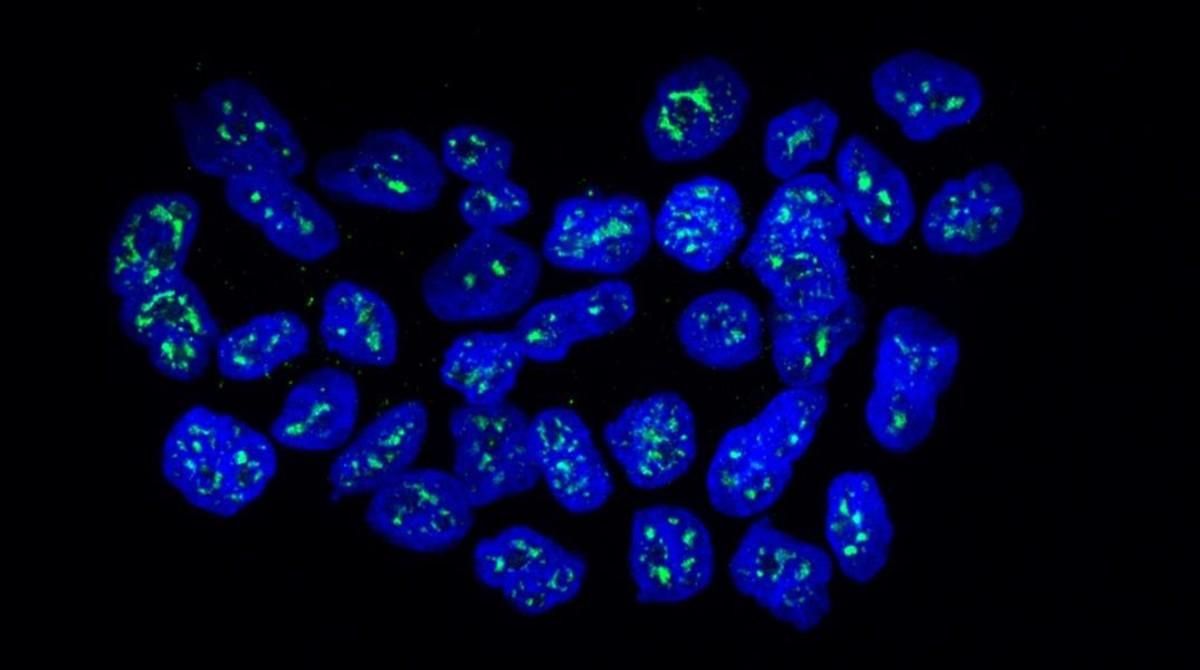 Núcleos de células metastáticas de cáncer de mama con la proteína MSK1 en verde. Núcleos de células metastáticas de cáncer de mama con la proteína MSK1 en verde.