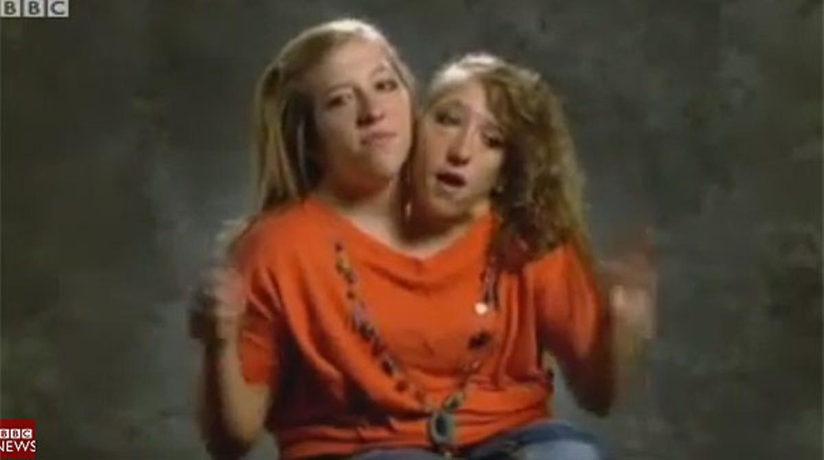 Documental de la BBC sobre dos siamesas con un mismo cuerpo